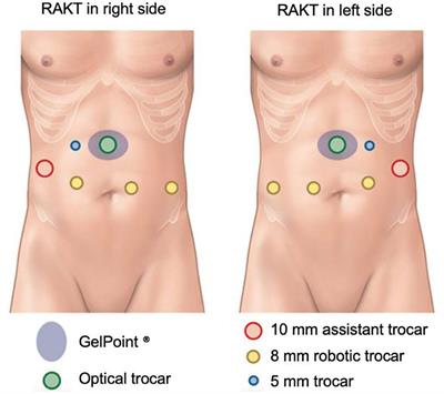 ABO-Incompatible Robotic-Assisted Kidney Transplantation in the Obese Recipient